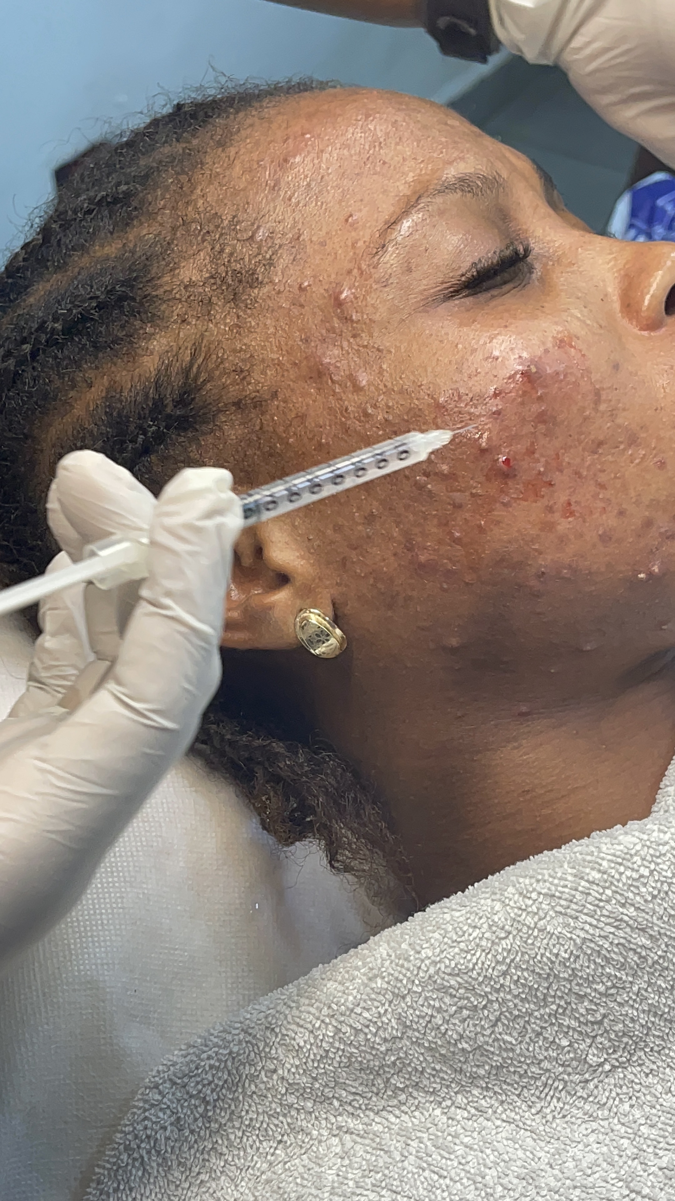 Acne Treatment Programs