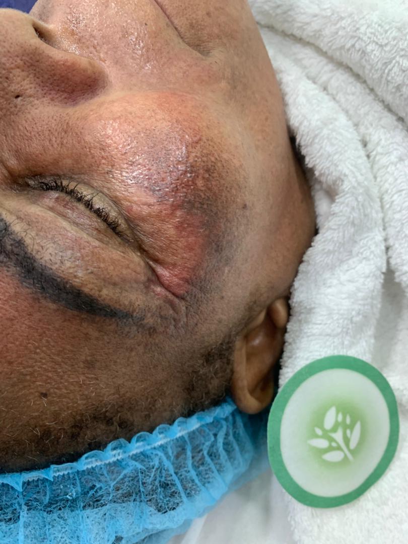 Hyperpigmentation, Sunburn & Melasma Treatment