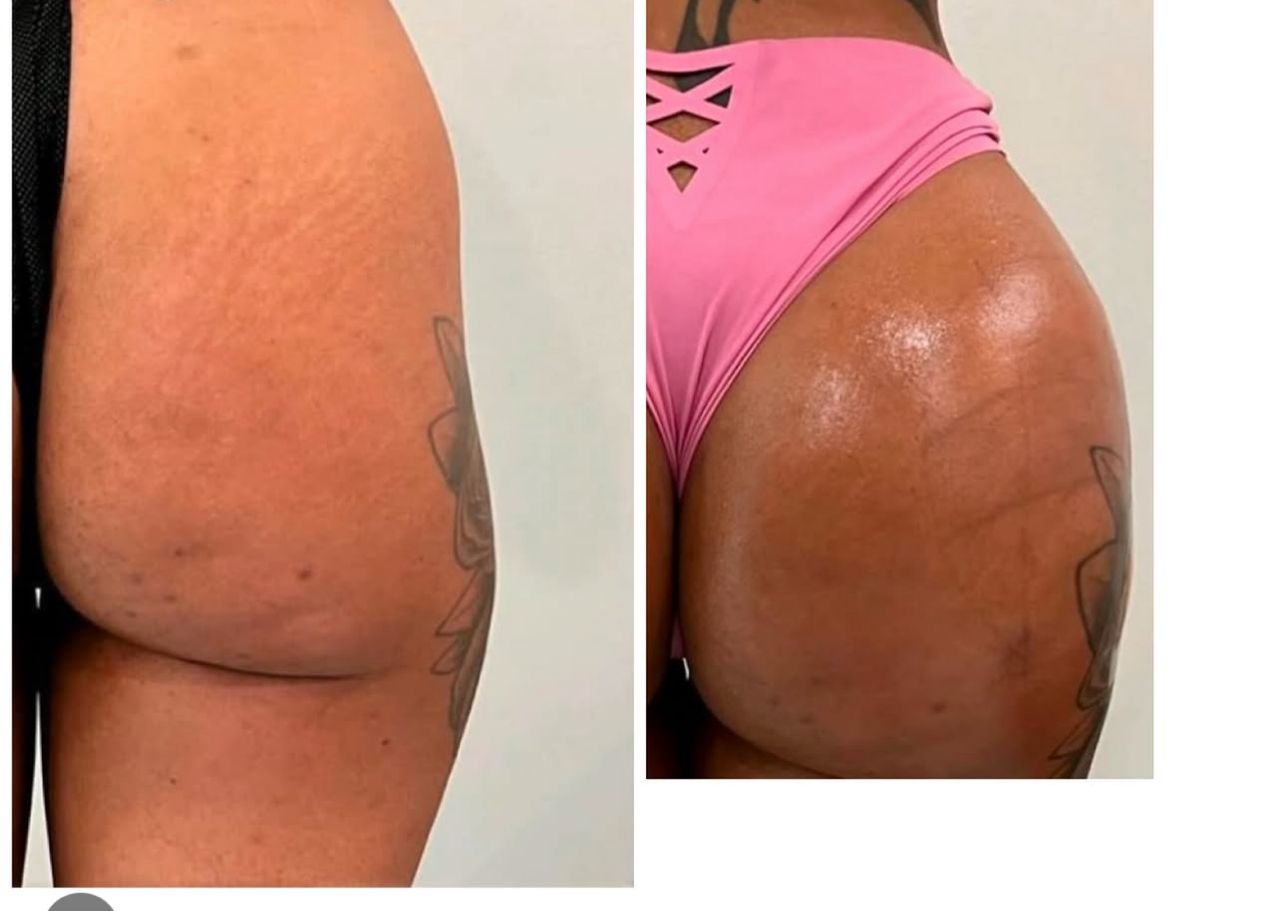 Restorative Fillers & Lifts